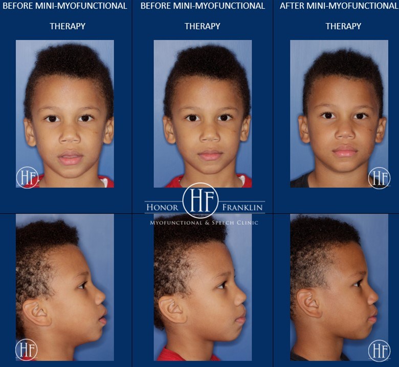 patient jacob's face before and after lip competence therapy