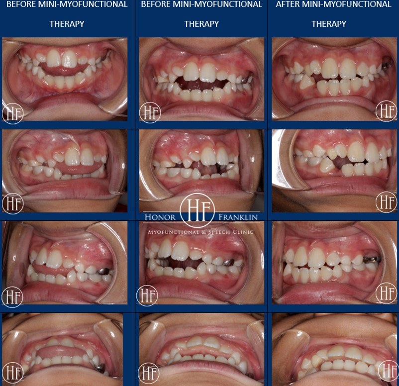 patient jacob's teeth before and after lip competence therapy