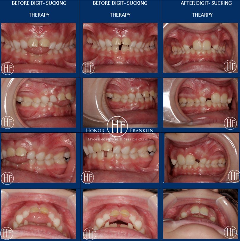 patient lola teeth pictures before and after digit sucking therapy