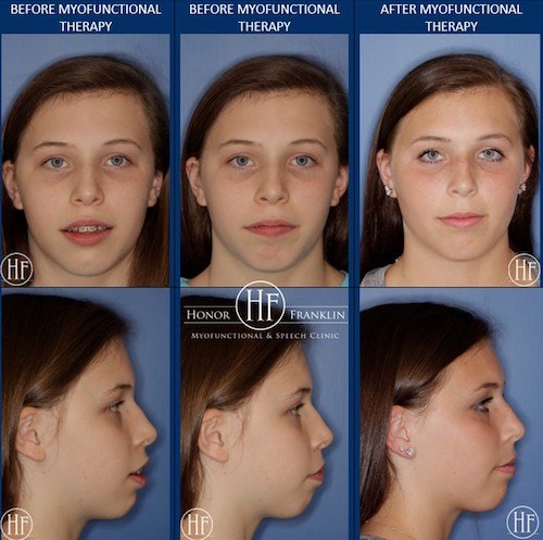 Orofacial Myology / Myofunctional Therapy - Reflective Smiles