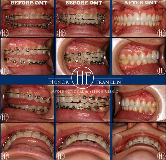 Before and After OMT Photos