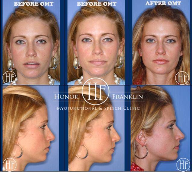 Before and After Face Photos of OMT Therapy 