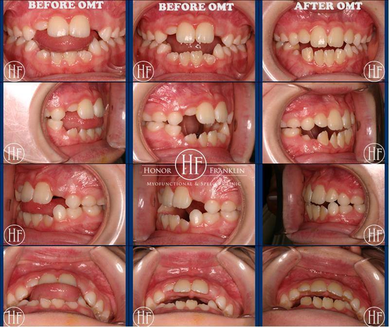 BEFORE & AFTER OMT PHOTOS