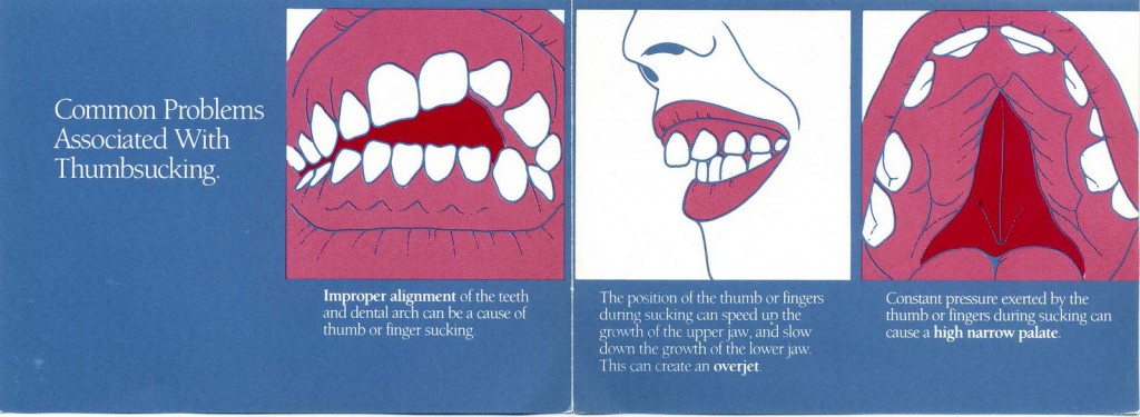 Common Problems Associated with Thumbsucking.