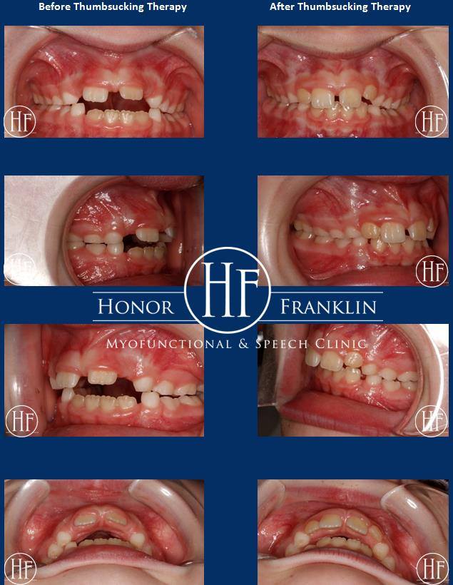 Thumbsucking Before & After Photos-Dr. Honor Franklin