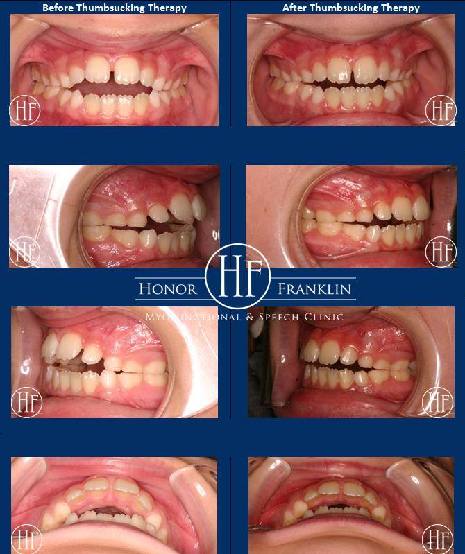 Thumbsucking Before & After Photos-Dr. Honor Franklin