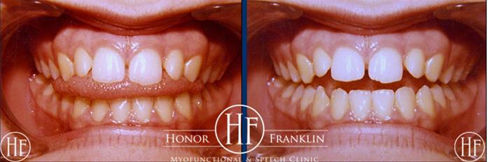 Before & After Orofacial Myofunctional Therapy