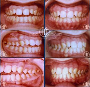 Before & After Orofacial Myofunctional Therapy