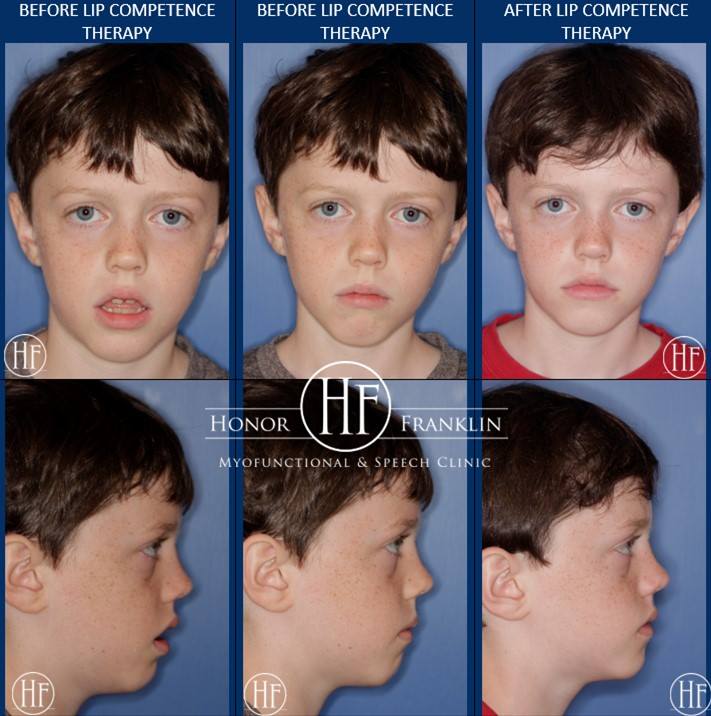 Before After Face Photos - 10 year- 11 month old boy,